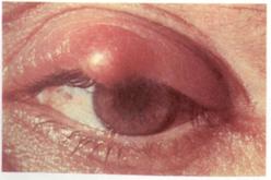 Ечемик на окото - причини, симптоми и лечение