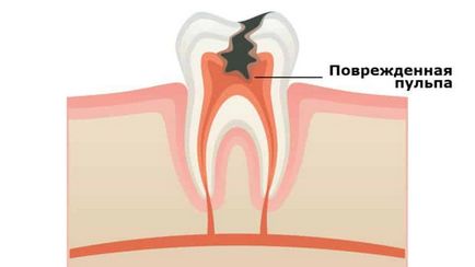 Зъбни пломби на зъбите в домашни условия как да се спре зъб