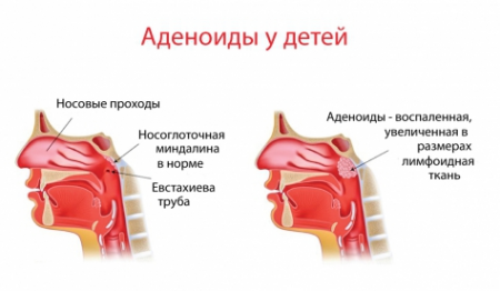 Аденоиди Какво има, симптоми, лечение при деца