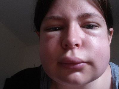 Алергичен оток на лицето, защо там, симптоми и лечение