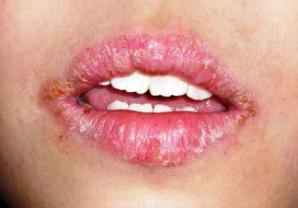 Алергии по устните симптоми и лечение