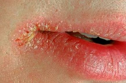 Алергии в хейлит на устните, къде и как да се отнасяме