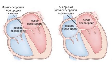 Аневризма на предсърдно септален аневризма МРР какво е