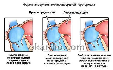 WFP аневризма (предсърдно септален) при възрастни и деца