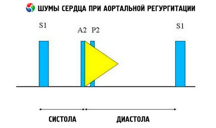 Аортните регургитация причини, симптоми, диагностика, лечение, които са компетентни за здравето на ilive