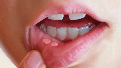 Бяла болки (язва) при вътрешната страна устна