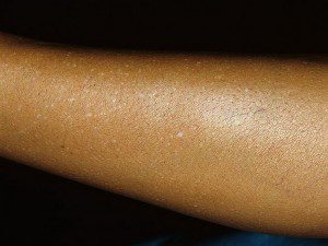 Бели петна по кожата причините и лечения