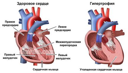 Big сърцето причинява, диагностика, лечение и прогноза на заболяването