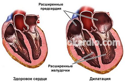 Big сърцето причинява, диагностика, лечение и прогноза на заболяването