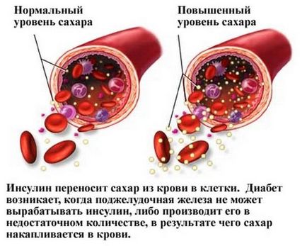 Декомпенсирана диабет какво е