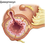 хранопровода дивертикул, симптоми и лечение