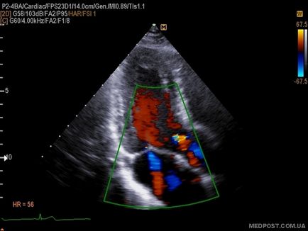 Ехокардиография или ултразвук на сърцето и кръвоносните съдове, medpost
