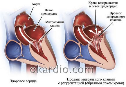 Предсърдно мъждене симптоми, лечение, и прогноза форма