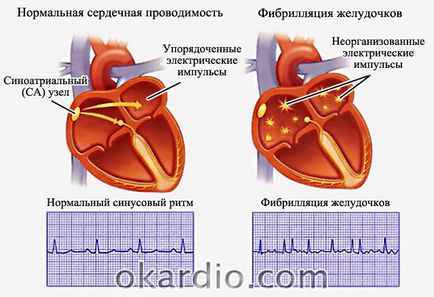 Предсърдно мъждене симптоми, лечение, и прогноза форма