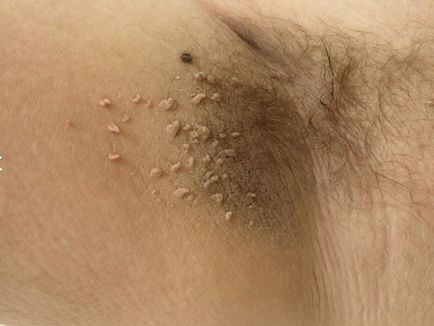 фибром на кожата какво е, причини за образуването и методи на лечение