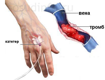 Флебит (възпаление вена) ръце и долните крайници симптоми, лечение