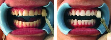 Фотоизбелващ зъбите преди и след снимки, преглед на сегашните системи