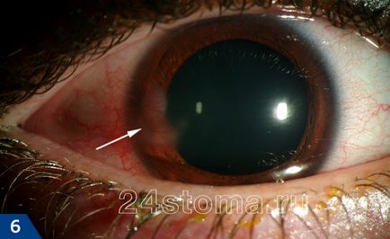 Херпес на окото - снимките, ефективна терапия, за да се избегнат усложнения