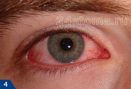 Херпес на окото - снимките, ефективна терапия, за да се избегнат усложнения