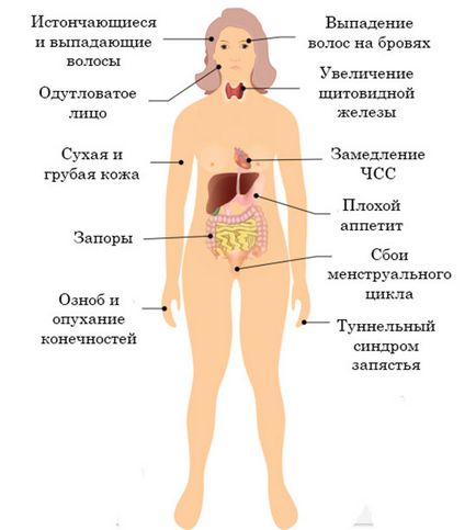 Хипотиреоидизъм е функция на щитовидната жлеза - това, което се причинява, симптоми и лечения