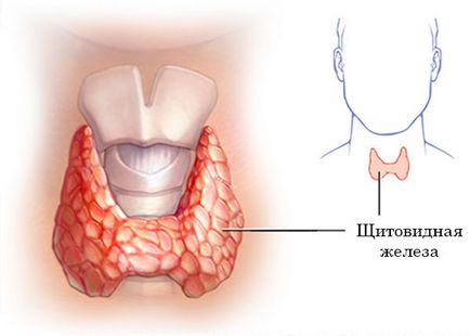 Хипотиреоидизъм е функция на щитовидната жлеза - това, което се причинява, симптоми и лечения