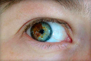 Очи с различен цвят (хетерохромия), това означава, че raznoglaziya на причините (снимка)