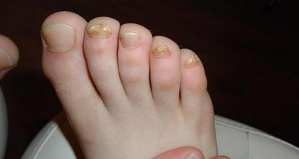 Гъбички по краката на снимка на детето, отколкото за лечение на крака и нокти