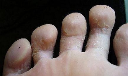 Гъбички по краката на снимка на детето, отколкото за лечение на крака и нокти