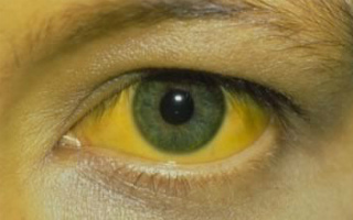 Ikterichnost склерата на очите причини и лечение