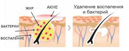 Как бързо да се отървете от акне по мнение дома лекар