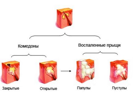 Как да се отървете от пъпки на вечер