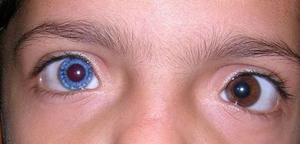 Как е феноменът, когато човек е с различен цвят на очите