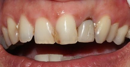 Кариесът на първични и постоянни зъби при децата, включително и причините, Етап ранна възраст и