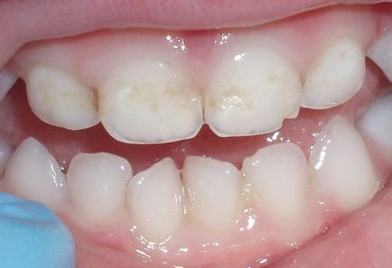 Кариесът на първични и постоянни зъби при децата, включително и причините, Етап ранна възраст и