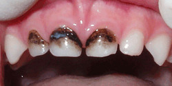 Кариес млечни зъби