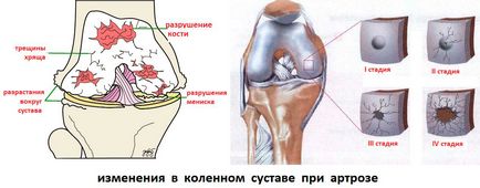 Лечение на остеоартрит на коляното народната отстранява
