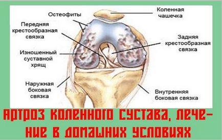 Лечение на остеоартрит на коляното народната отстранява