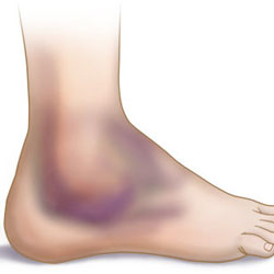 Лечение на хематом на крака си след контузия - как бързо да се отърве от синини