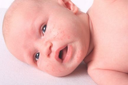 Малки пъпки по лицето на новородено бяло, червено