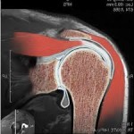 MRI на раменната става като правиш, че може да бъде открит