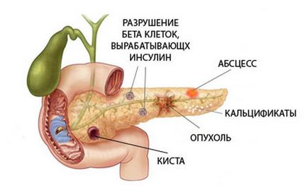 панкреаса хетерогенна структура, която е