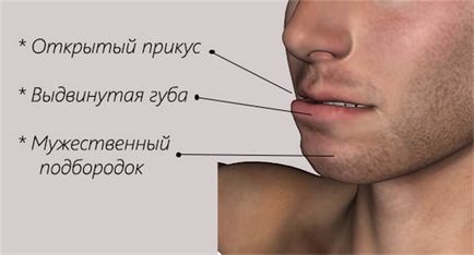 Захапка (долната челюст се премества напред) определи с помощта на ортопедични системи и