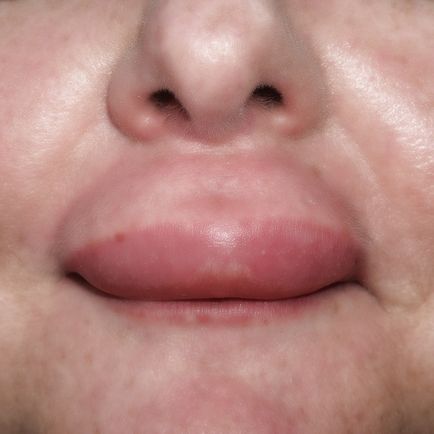 Подуване на устните - тя може да бъде от основните причини за