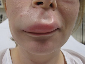Подуване на устните, което може да бъде причина, отколкото да помогне да се отървете от подуването на лицето си