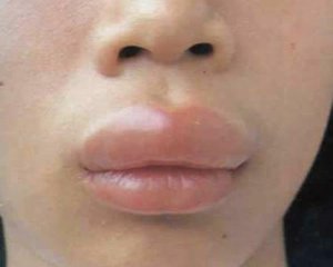Подуване на устните, което може да бъде причина, отколкото да помогне да се отървете от подуването на лицето си