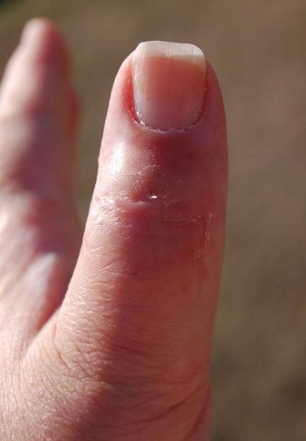 Подуване на пръста на ръката си причини и лечения