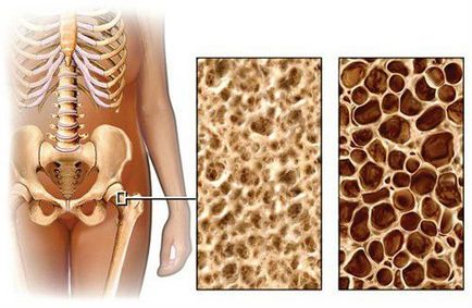 Остеопорозата е това, което е, симптоми и лечение на заболявания на костите