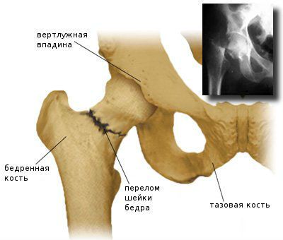 Остеопорозата е това, което е, симптоми и лечение на заболявания на костите