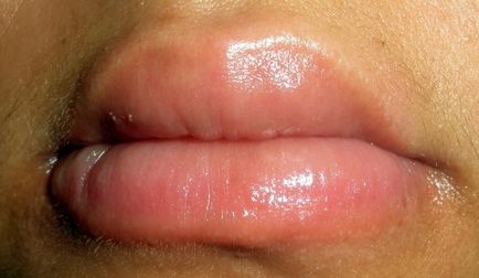 Подуването на причината и лечението устни (отстраняване на подуване от устата)