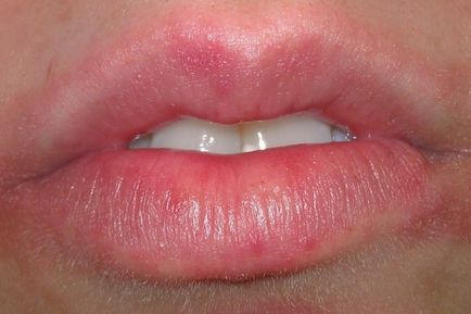 Подуването на причината и лечението устни (отстраняване на подуване на устата)